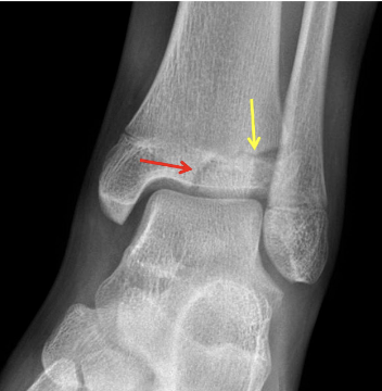 <p>What fracture is this?</p>