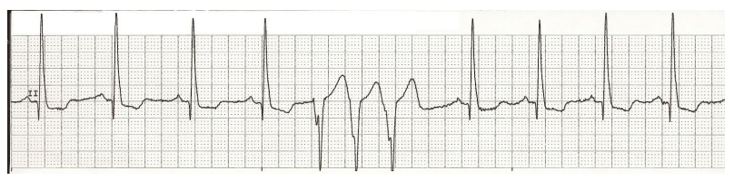 <p>When three PVCs are next to each other, this is called a _______</p>