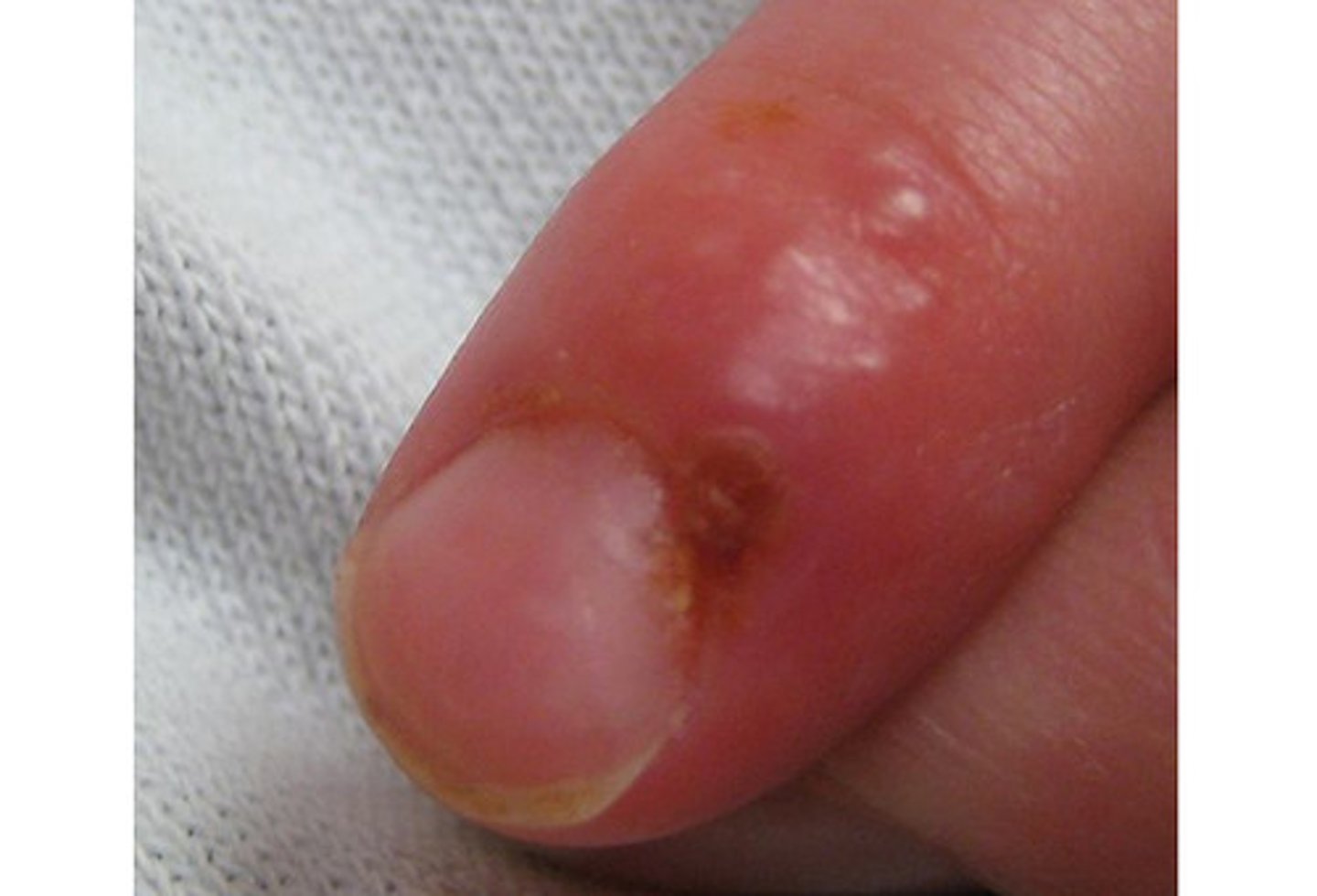 <p>Recurrent and painful HSV infection of the fingers</p>