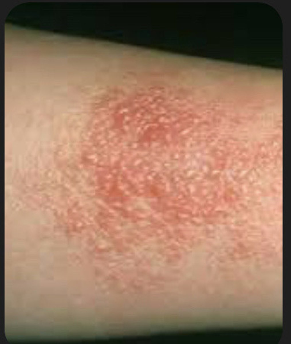 <p>irritant and allergic</p>