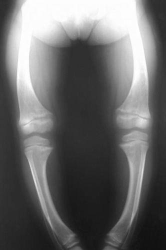 Vitamin D deficiency in children


Bowlegged appearance