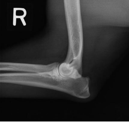 <p>what radiographic view of the elbow is shown?</p>