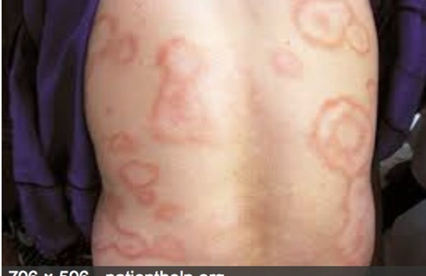 <p>erythema marginatum</p>