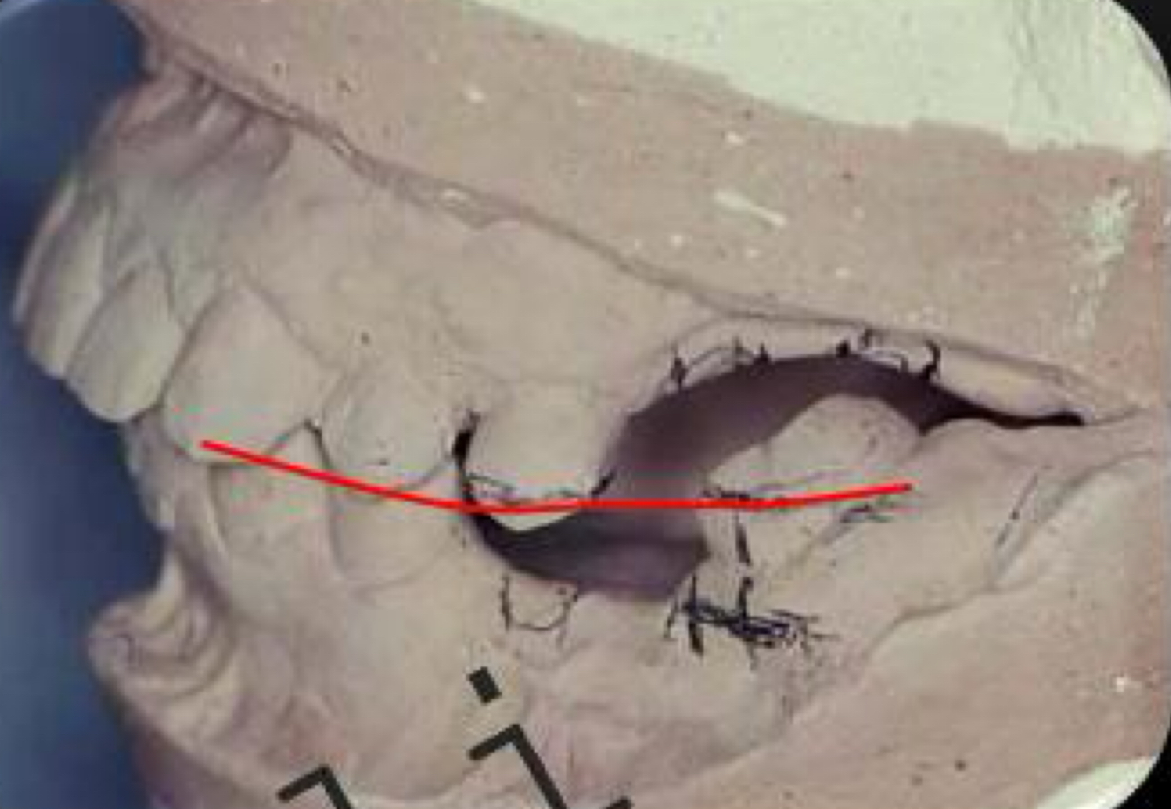 <p>what is the goal of the surgical preparations of malposed teeth?</p>