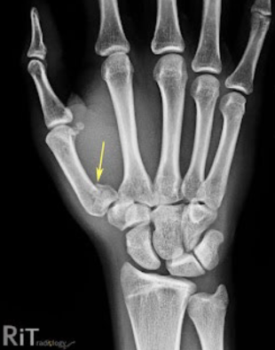 <p>Longitudinal fracture at base at first metacarpal with fracture line entering the CMP joint</p>