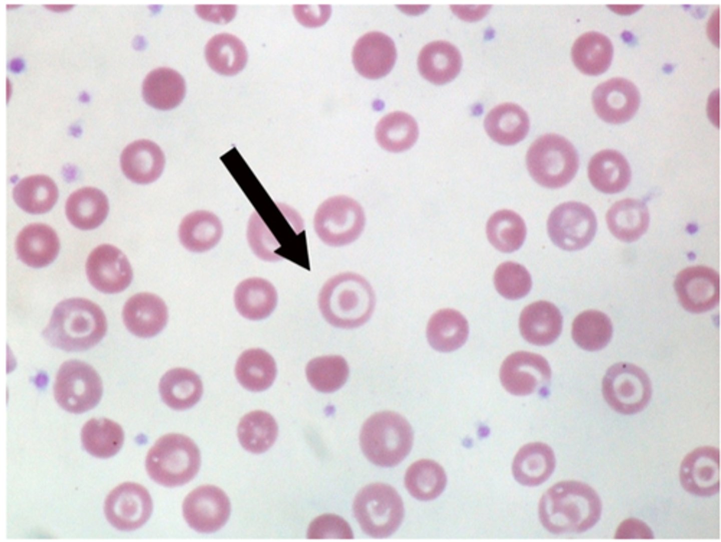<p>-are red blood cells with a central density surrounded by pallor (bull's eye appearance). They are usually seen in pts with hemoglobinopathies (e.g thelassemia) or chronic liver disease (especially obstructive liver disease)</p>