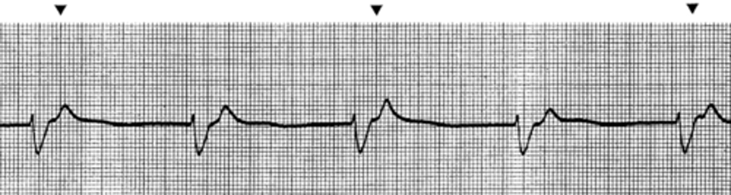 <p>A small device inserted into the heart which regulates the beat and keeps blood pumping around the body</p>