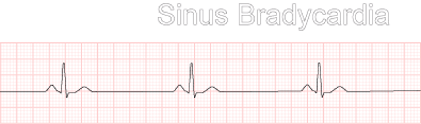 <p>Heart beats too slow, longer wider waves</p>