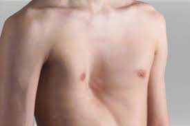<p>What is another name for funnel chest?</p>