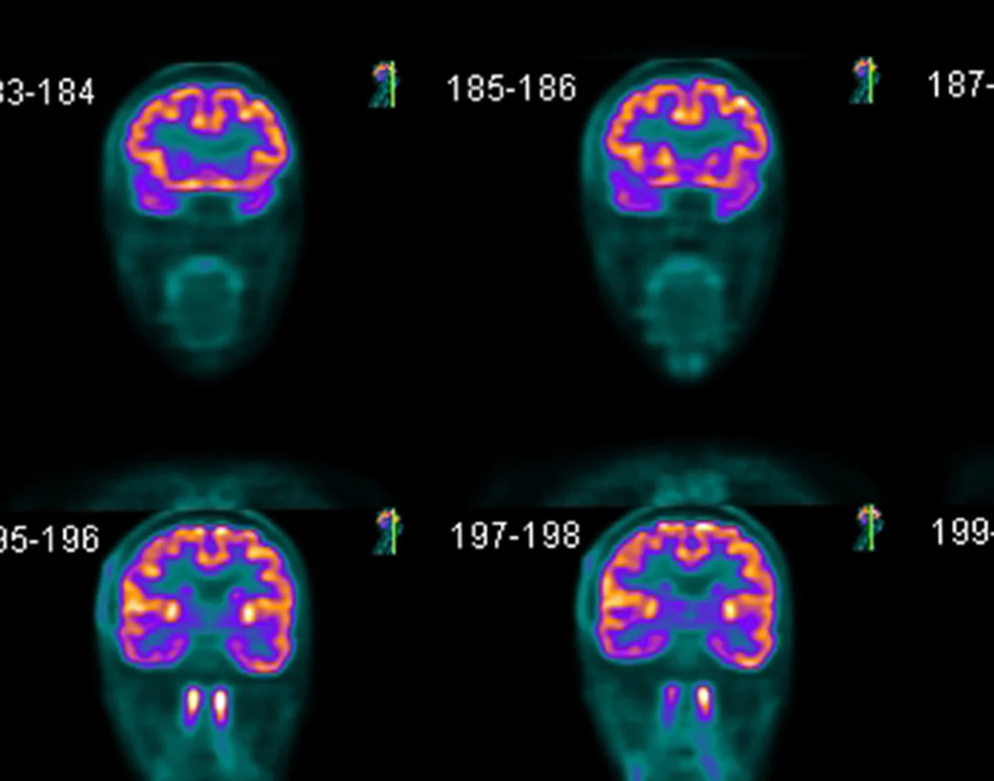 <p>PET scan (Positron Emission Tomography)</p>