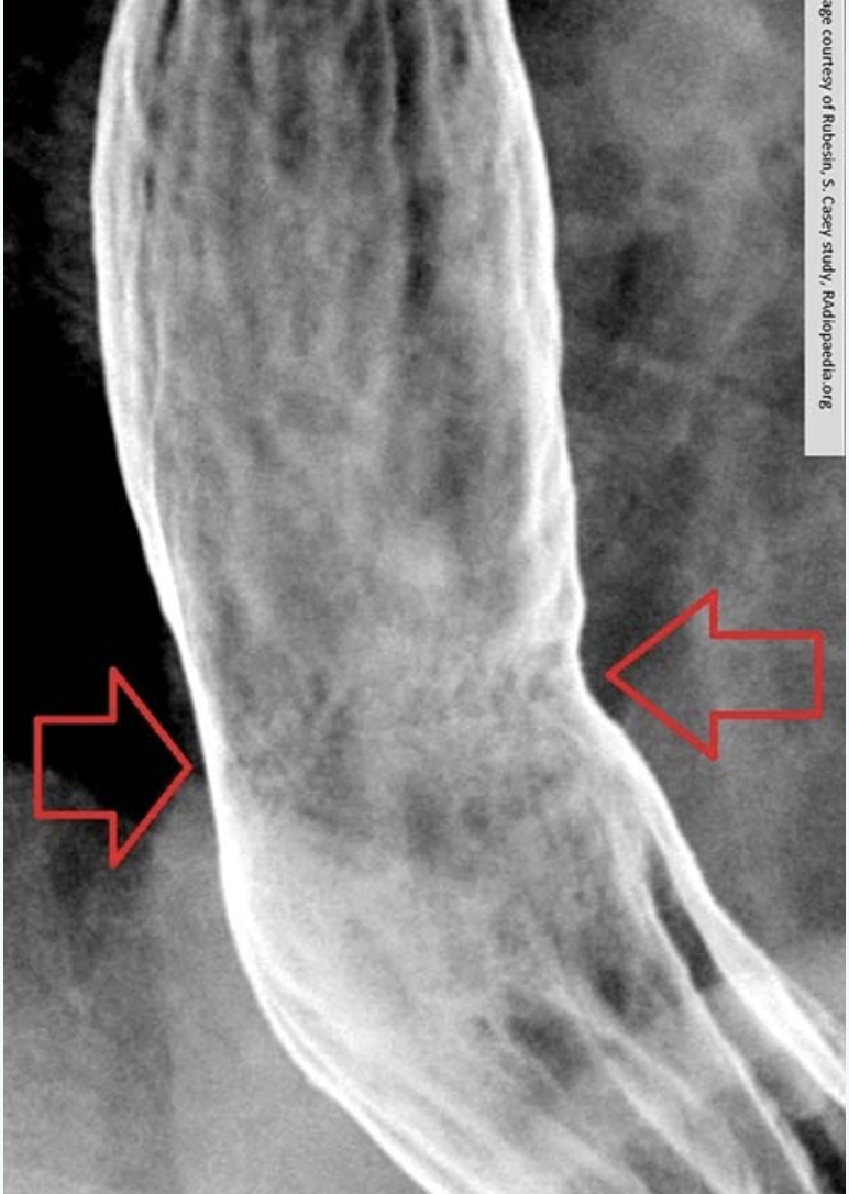 <p>what is Barrett’s Esophagus?</p>