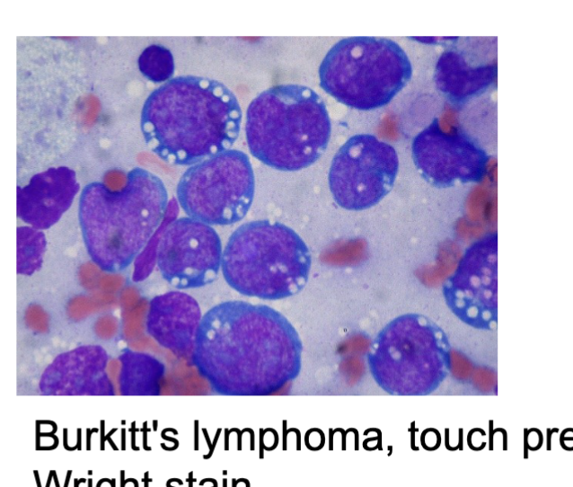 <ul><li><p>A rare but aggressive lymphoma that is particularly common in children and young adults in Africa and other tropical regions.</p></li></ul><p></p>