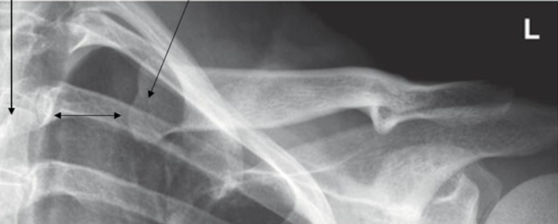 <p>how do you fix this AP clavicle</p>