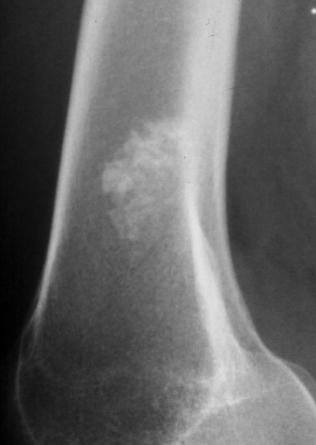 <ul><li><p><strong>Cause</strong></p><ul><li><p>Osteochondroma, osteoma, odontoma, exostosis</p></li></ul></li><li><p><strong>Signalment</strong></p><ul><li><p>Old animals</p></li></ul></li><li><p><strong>CS</strong></p><ul><li><p>asymptomatic</p></li></ul></li><li><p><strong>RS</strong></p><ul><li><p>Sharp transition, min periosteal reaction, no lysis, <strong>osteoproduction</strong></p></li></ul></li></ul><p></p><p></p>