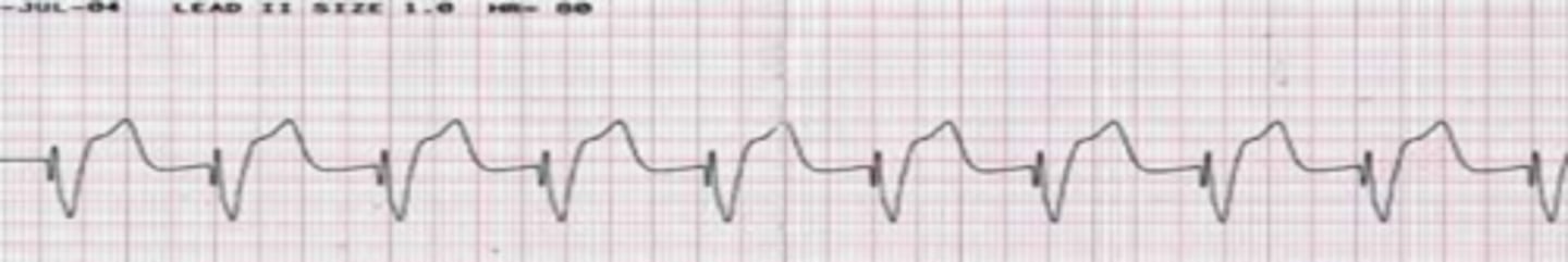 <p>Which Arrythmia is this?</p>