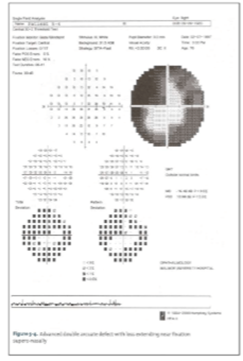 <p>central island of vision only</p><p>image - double arcuate scotoma</p>