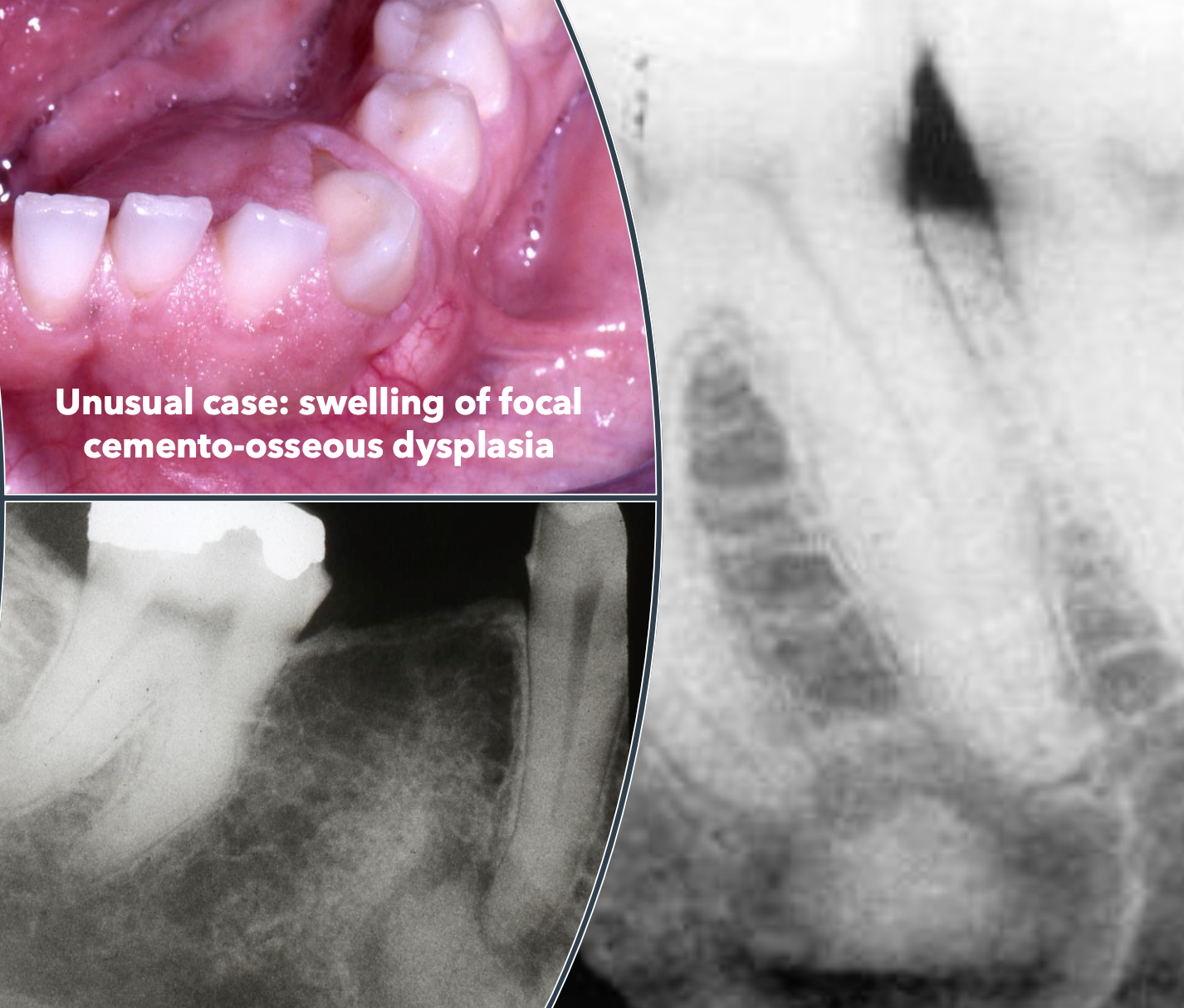 <p>What are some clinical features of focal cemento-osseous dysplasia?</p>