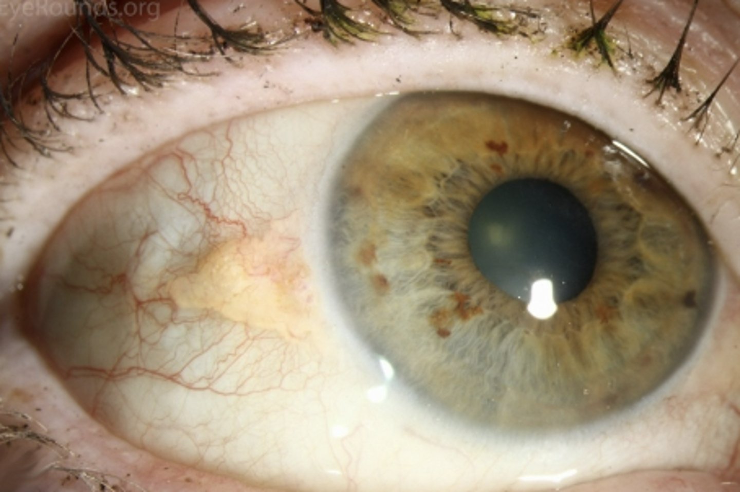 <p><u>Etio</u>: <strong>common &gt;35 yo</strong>, deposit of protein, fat, or calcium caused by aging</p><p><u>S&amp;S</u>: <strong>yellow bump</strong>/growth on conjunctiva of eye, rarely grows on cornea</p><p><u>Tx</u>: no treatment; pt reassurance</p>