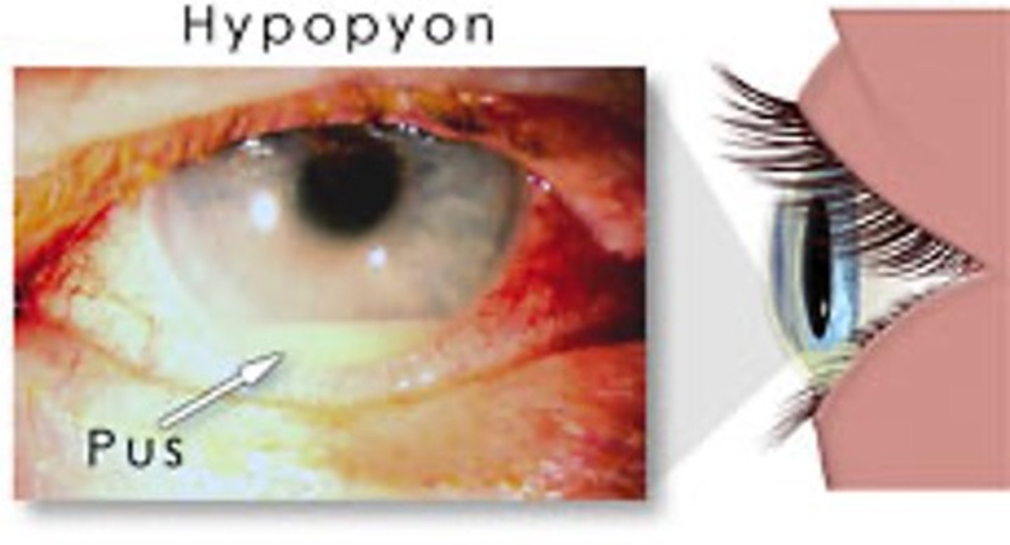 <p>pus in the anterior chamber related to infection or inflammation</p>