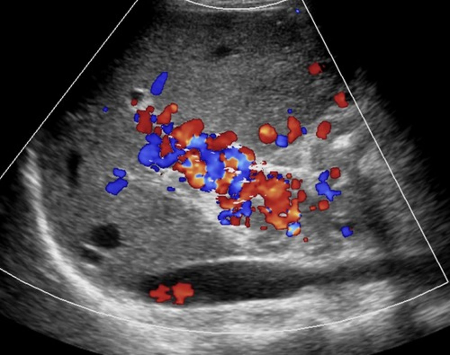 <p>Due to chronic portal vein thrombosis</p><p>Occurs within 6 days after thrombotic event</p><p>Absent portal vein flow</p><p>Formation of new peri-portal vessels around portal vein</p><p>Hepatopetal flow within serpentine vessels</p>