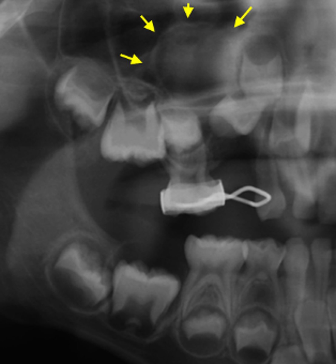 <p>ID the cyst:</p><p>- Well-defined corticated lesion</p><p>- radiolucent</p><p>-LOSS of lamina dura</p><p>- displaces floor of maxillary sinus</p>