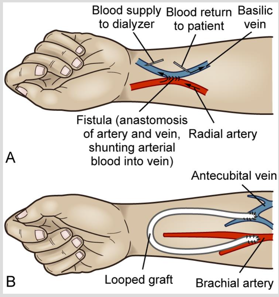 <p>combining a vein and an artery</p><ul><li><p>hear a bruit</p></li></ul><p></p><p>same thing except another device combines them</p><ul><li><p>has a thrill</p></li></ul><p></p>