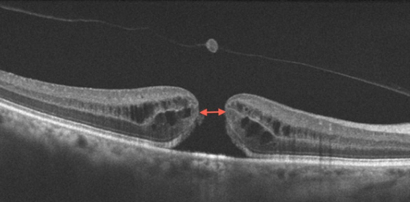 <p>full hole at macula</p><p>parafoveal CME</p><p>foveal tissue attached to posterior hyaloid</p>