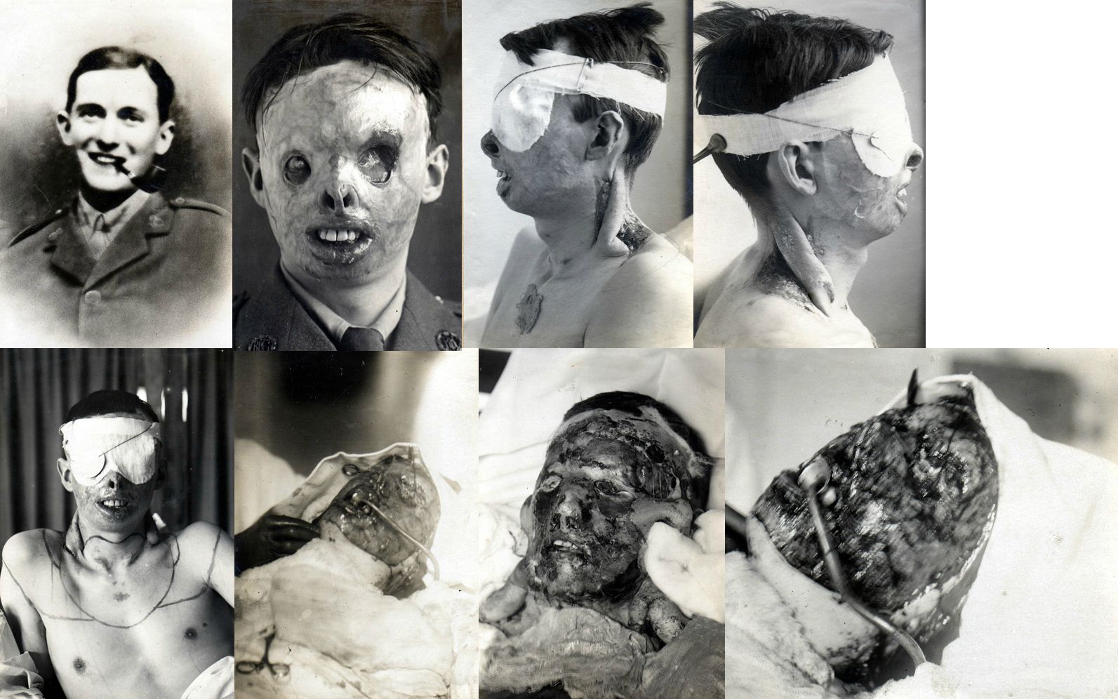 <p>WWI Plastic Surgery Patients</p>