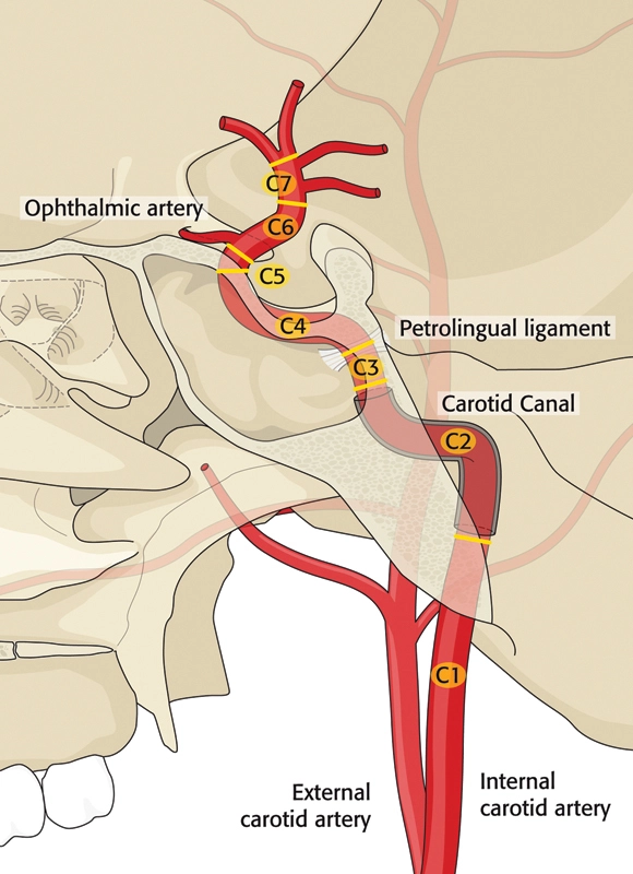 <p>Origin: Arises from common carotid</p><p>Terminates: <mark data-color="yellow" style="background-color: yellow; color: inherit">Carotid canal</mark> in temporal bone (petrous part)</p><p>Contains: <mark data-color="blue" style="background-color: blue; color: inherit">Carotid sinus</mark>, <mark data-color="yellow" style="background-color: yellow; color: inherit">innervated by CNIX (glossopharyngeal)</mark></p>