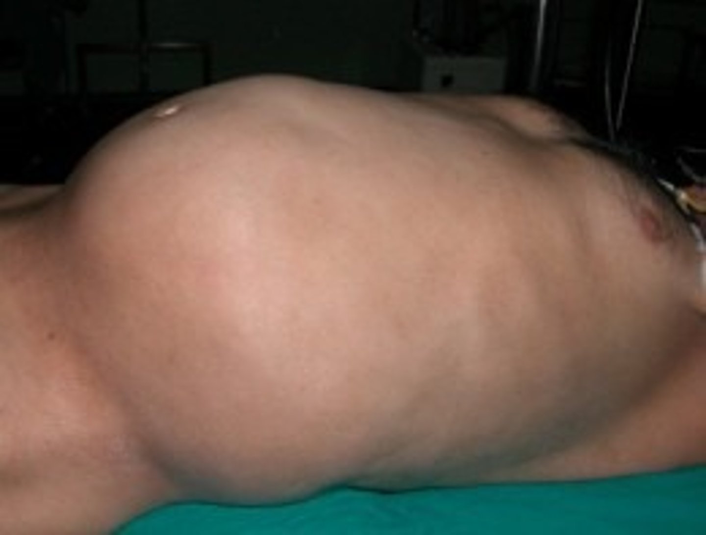 <p>the state or act of extending or being swollen out of shape</p>