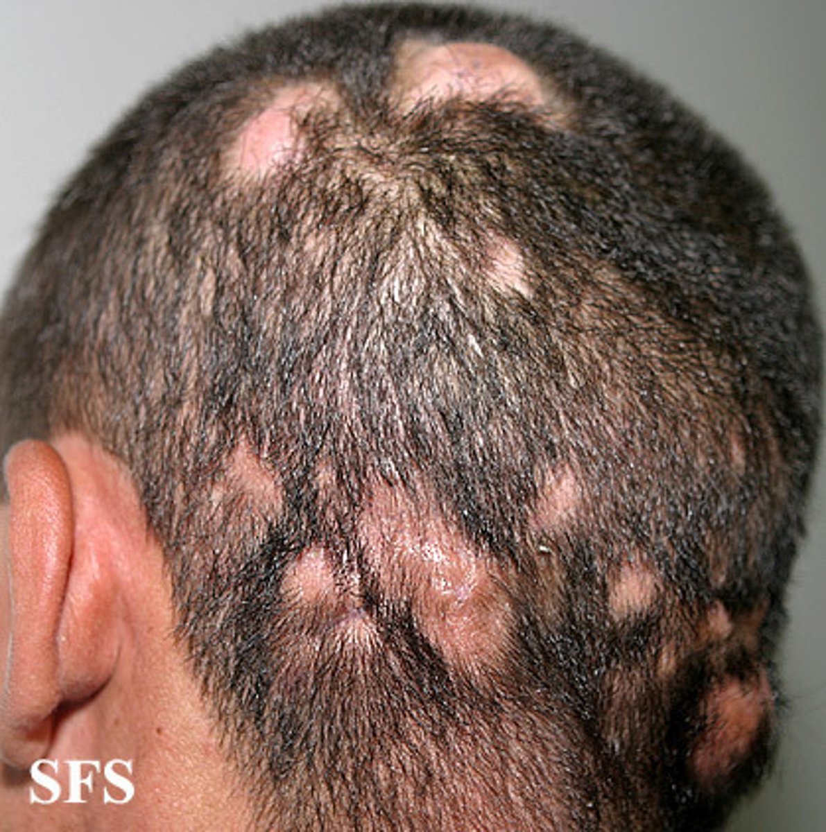 <p>fungal infection of scalp</p><p>-patches of alopecia</p>