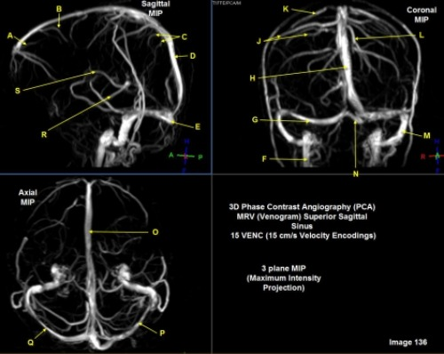 <p>Letter D in Image 136 is pointing to:</p><p>A. Right transverse sinus</p><p>B. Left transverse sinus</p><p>C. Sigmoid sinus</p><p>D. Superior sagittal sinus</p><p>E. Vein of trolard</p>