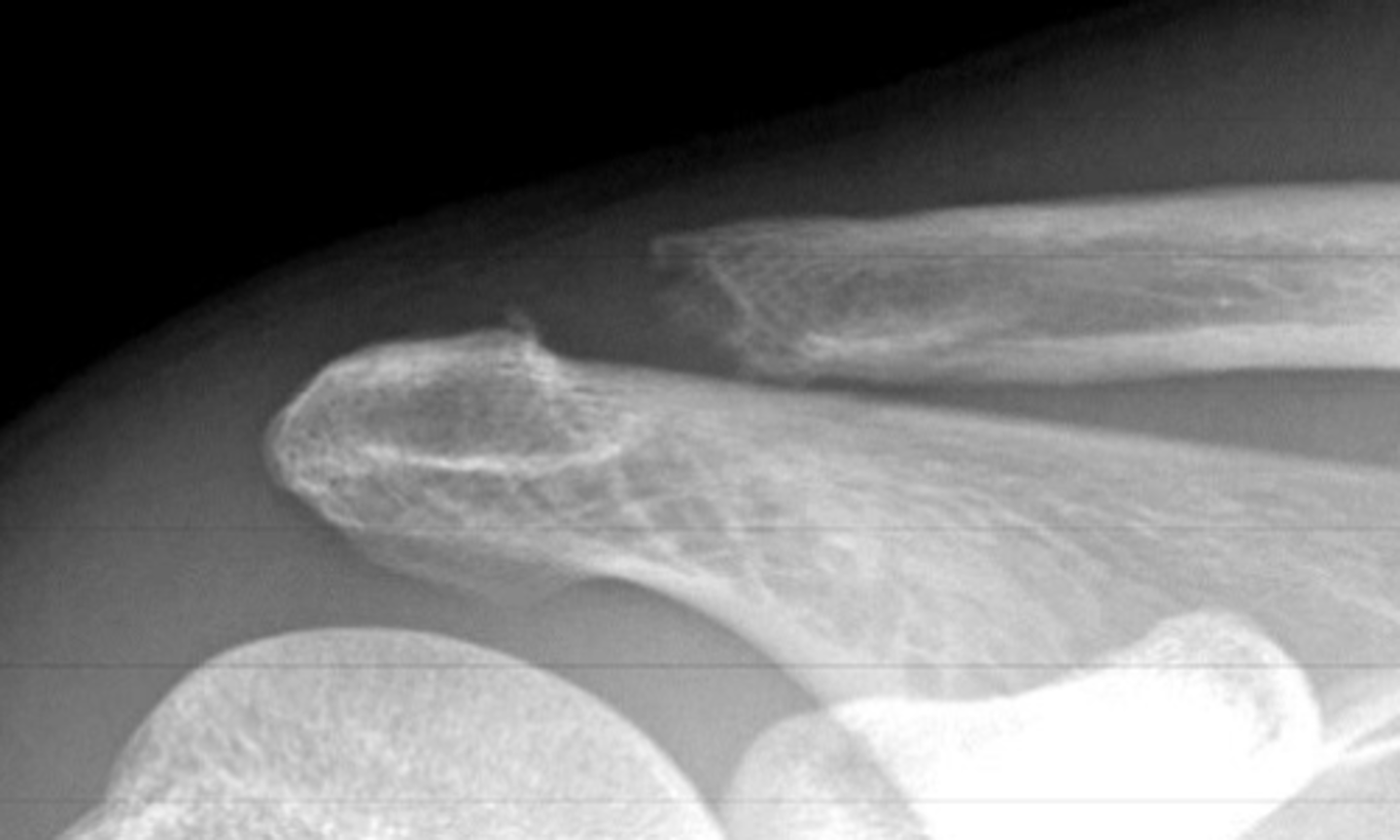 <p>frayed clavicle</p>