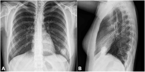 <p>Infection caused by the yeast-like organism <em>Histoplasma capsulatum</em></p>