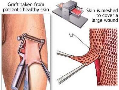 <p>c) Oscillating-blade dermatome</p>