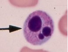 <ul><li><p>condensing of nucleus as cell dies </p></li></ul><p></p>