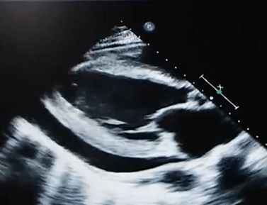 <p><span><span>The image below is an example of what cardiac pathology:</span></span></p><p>Pericardial effusion</p><p>Constrictive pericarditis</p><p>Constrictive Pericarditis with pericardial effusion</p><p>Acute pericardial effusion</p>