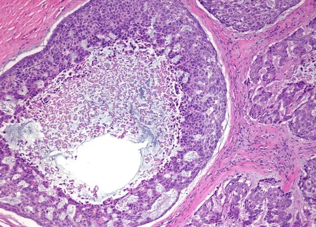 <p>Homme de 80 ans avec masse à croissance rapide de la parotide </p><p>1) Diagnostic</p><p>2) épidéimologie (âge, pronostique, localisation) </p><p>3) Histologie</p><p>4) IHC</p><p>5) moléculaire </p>