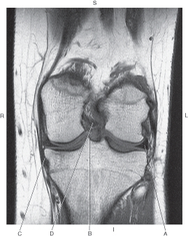 <p>In the figure below of a coronal, T1-weighted MRI of the knee, which line points to the posterior cruciate ligament?</p>