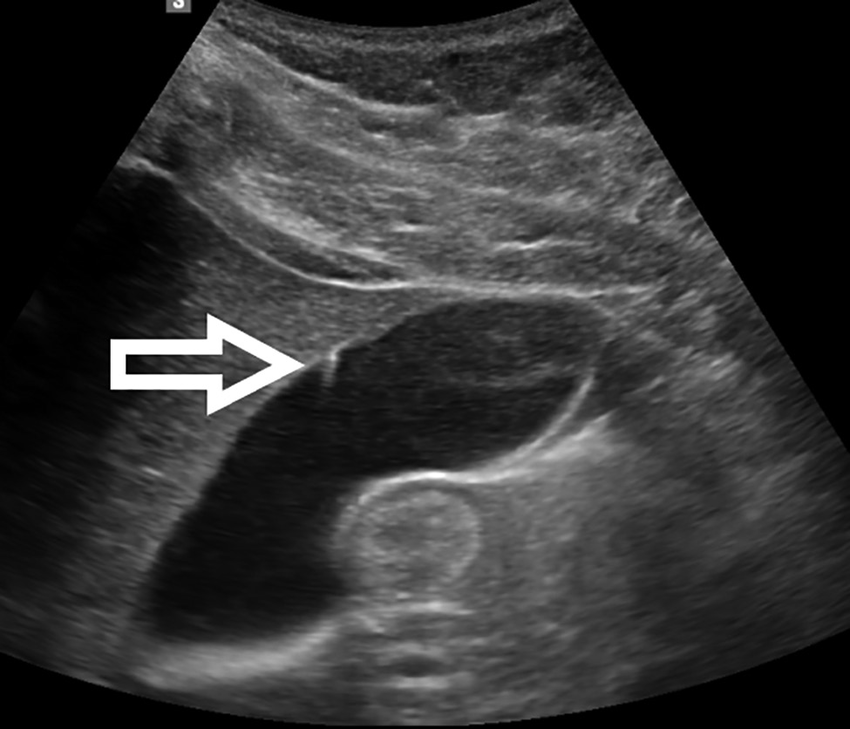 <p>Reverberation seen in Adenomyomatosis </p>