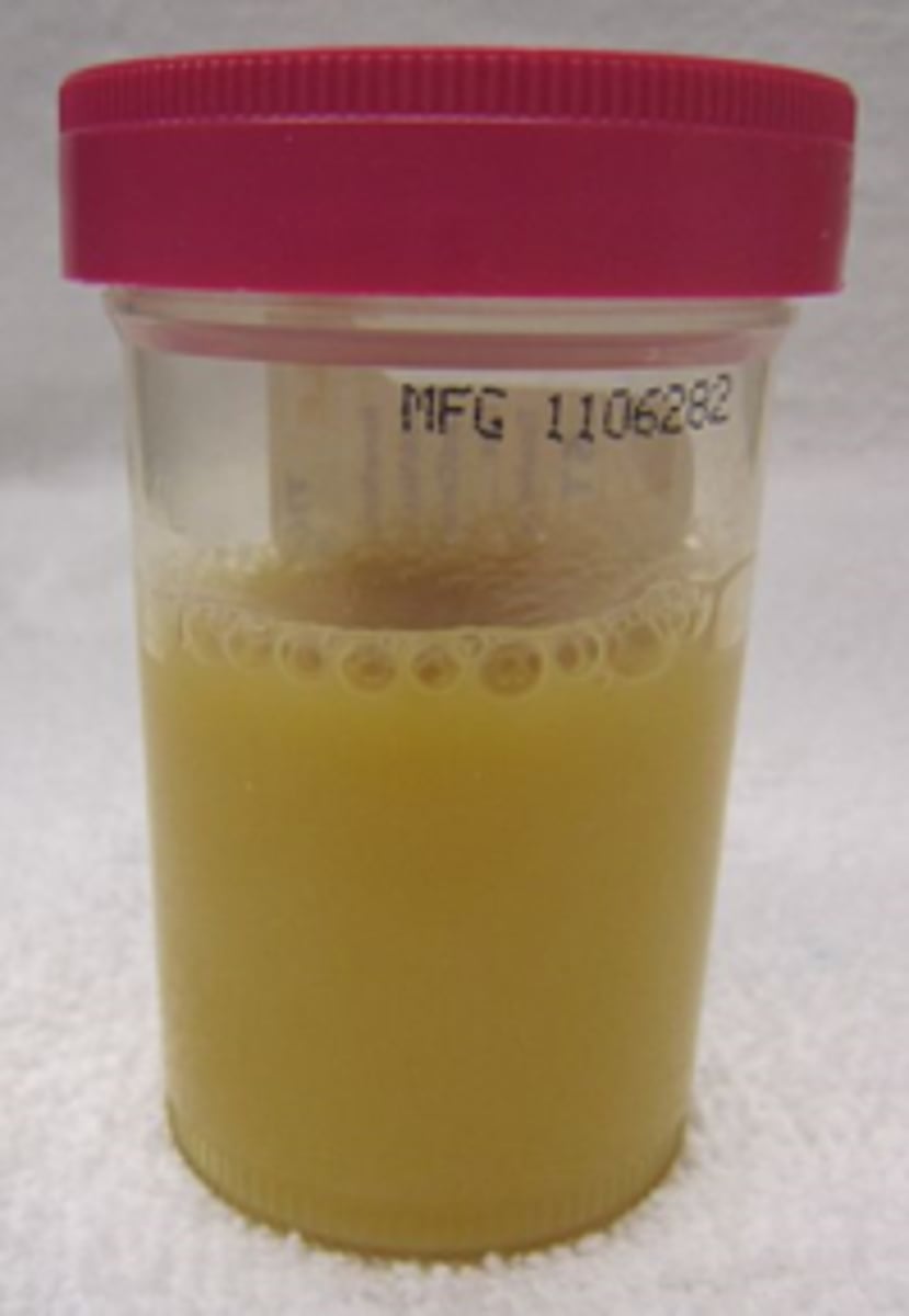 <p>WBC or pus in Urine meaning the body is fighting an infection</p>