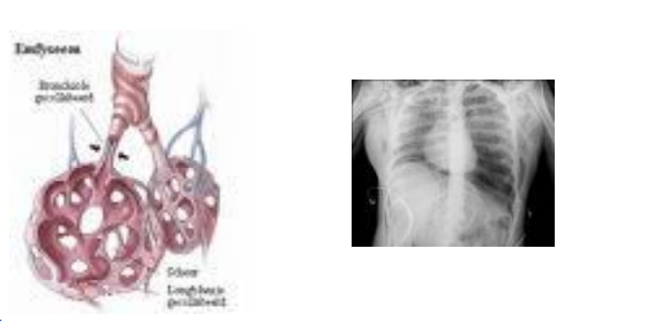 <p>Destructie van alveolaire septa en soms respiratoire bronchiolen → ontstaan van grote luchtruimten =&nbsp; hyperinflatie</p><p>Longen zien er bleek en opgeblazen uit</p>
