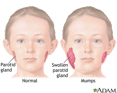 <ul><li><p>Sudden onset of<strong> bilateral parotitis </strong>(swelling of the parotid glands) and fever</p></li><li><p><strong>Swelling of other glands</strong>: orchitis, epididymoorchitis, oophoritis, mastitis, pancreatitis (with or without parotitis)</p></li></ul><p></p>