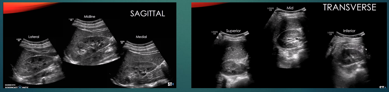 <ul><li><p>Patient prepped like an abdomen study, plus a full bladder</p></li><li><p>Patient is scanned in supine, LLD, and RLD </p></li><li><p>Scan both kidneys</p><ul><li><p>Compare the renal parenchyma to the liver (right) and spleen (left) </p></li><li><p>Kidney should appear slightly hypoechoic or isoechoic to these structures</p></li></ul></li><li><p>Take longitudinal images, sweeping through the entire kidney (lateral/mid/medial)</p></li><li><p>Take transverse images, sweeping through the entire kidney (superior to inferior)</p></li><li><p>Measure the kidney in long and transverse</p><ul><li><p>Not included in all protocols</p></li></ul></li></ul><p></p>