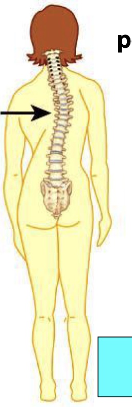 <p>What type of abnormal curve is this?</p>
