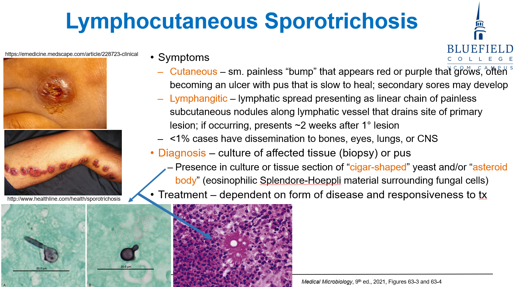 <p>C. Ulcerated lesion with nodules along lymphatics<br></p><p><em>Sporothrix</em> spreads <strong>along lymphatics</strong>, forming <strong>subcutaneous nodules</strong>.</p>