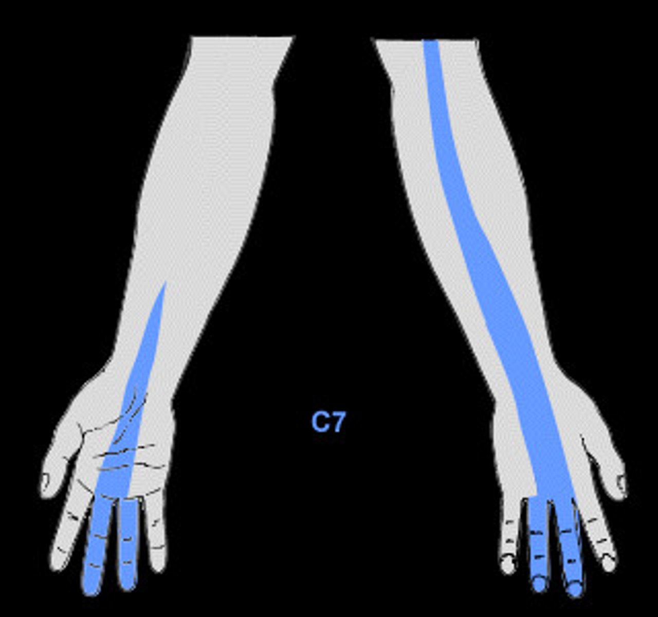 <p>Dermatome: Lateral arm/forearm to index, long and ring fingers</p><p>Muscles innervated: Triceps, wrist flexors</p><p>Reflexes (if any): Triceps</p><p>Paresthesias: Index, long, and ring fingers</p>