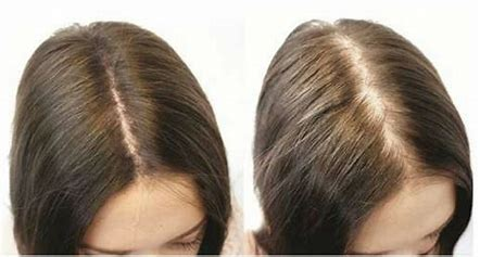 <p>the hair becomes thin throughout the scalp (no bald spots)</p>