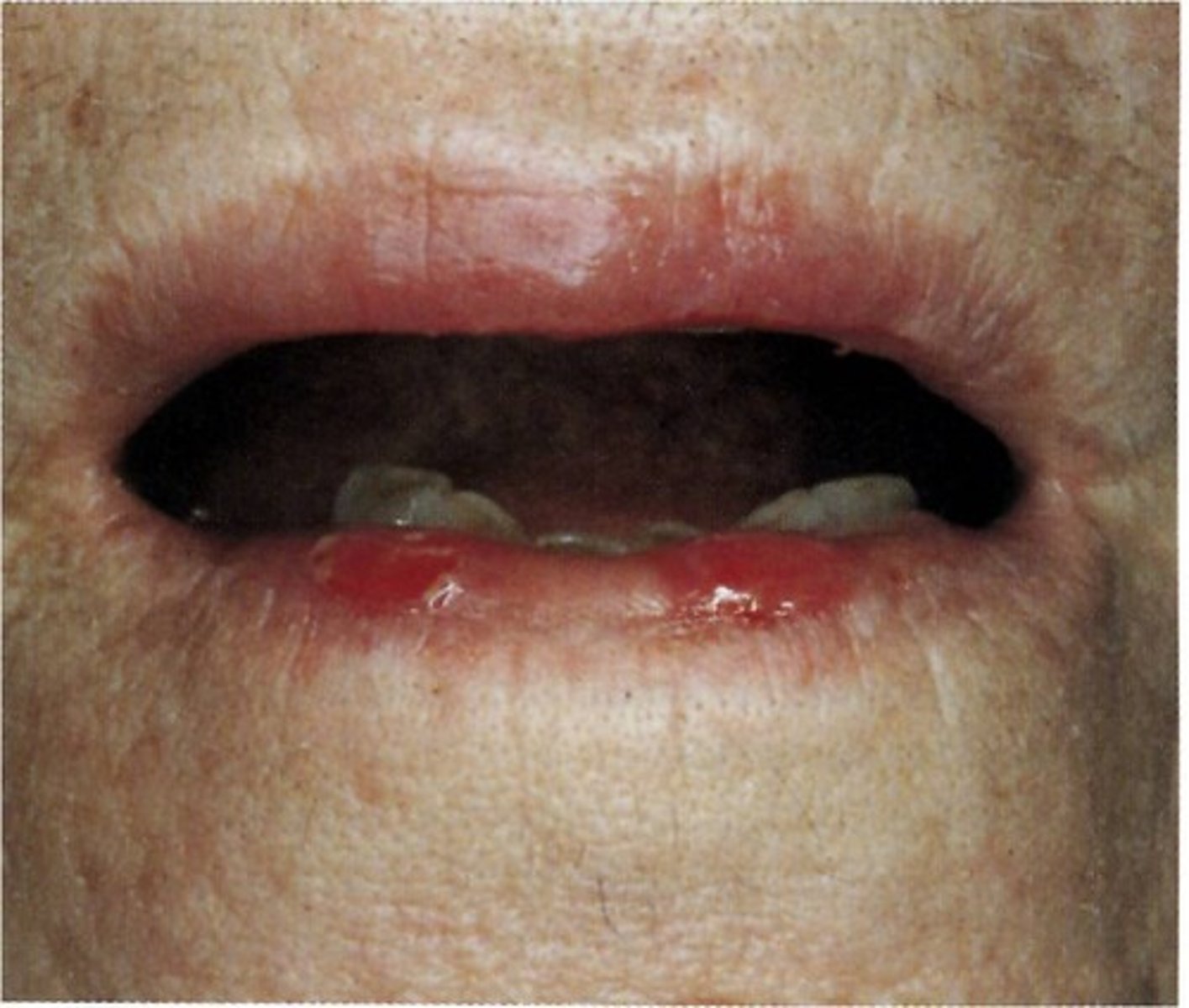 <p>Pemphigus Vulgaris</p>