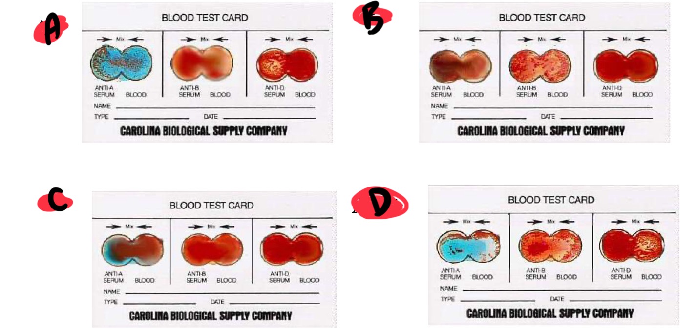 <p>Blood type A is</p>